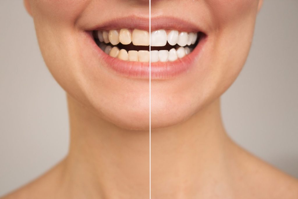 Teeth Whitening before and after